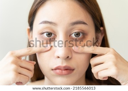 lack of sleep problem,  Worried Asian young woman pointing finger at dark circles under her eyes