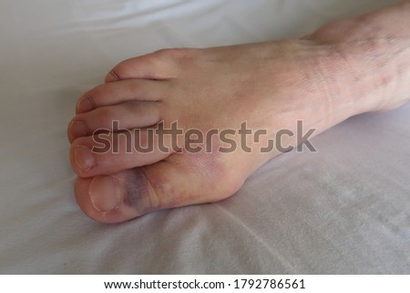 A ladies foot injured by a falling piece of agricultural machinery resulting in a  broken bone with severe swelling and bruising.