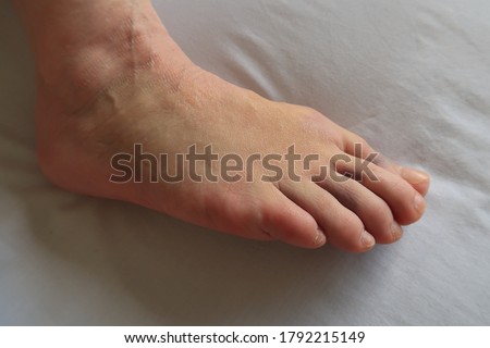 A ladies foot swollen and bruised caused by falling piece of machinery resulting in a crush injury.