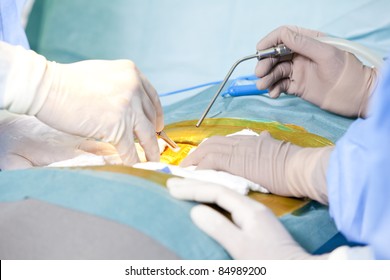 Laminectomy