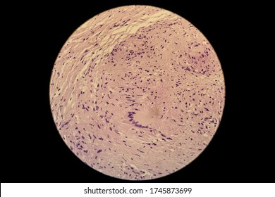Langerhans cells (LC) are members of the dendritic cells family, residing in the basal and suprabasal layers of the epidermis and in the epithelia of the respiratory, TB granuloma.