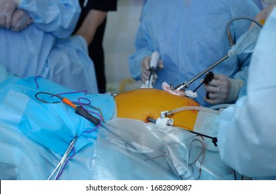 Laparoscopy Surgery Surgeon Hand Holding Laparoscopic Stock Photo ...