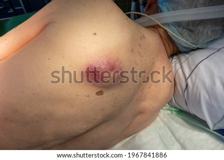 a large abscess grows on the back of a patient