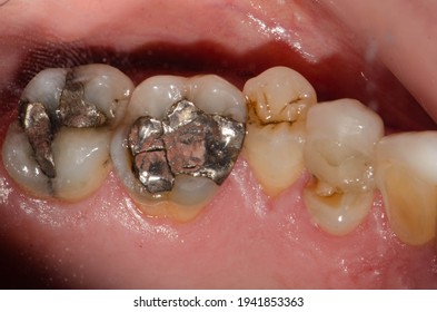 A Large Amalgam Or Metal-mercury Fillings On Molar Teeth And Premolar Tooth Fracture