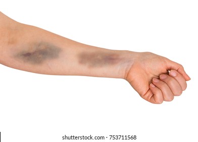 Large Bruise On Human Arm. Injection Bruises. 