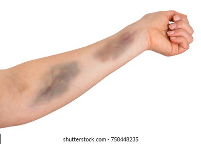 Large Bruise On Human Arm. Injection Bruises. 