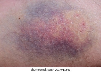 Large Bruise On Human Skin.