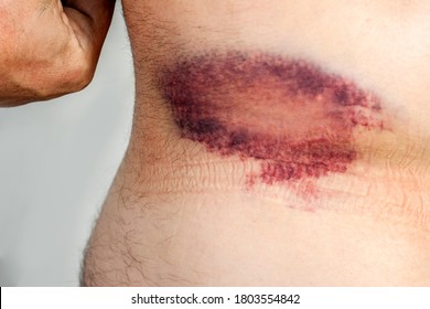 Large bruise on the man's body. Subcutaneous injury on human skin, painful blue bruise