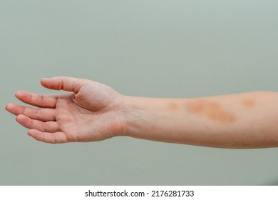 Large Bruise On Woman's Arm Isolated On White Background