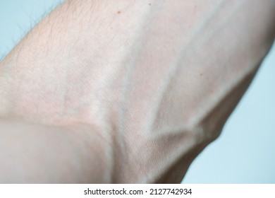 Large bulging veins and arteries on a man's arm close up. Varicose veins. Elbow bend.