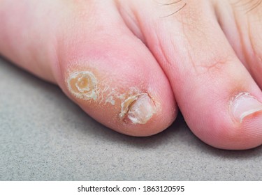 Large dry callus on the little toe of a man's foot. Consequences of wearing uncomfortable, tight shoes.