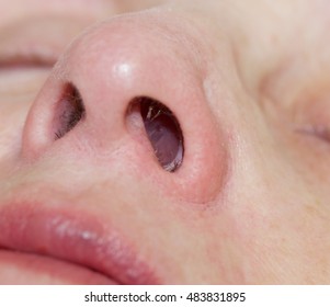 Nasal Polyp Images Stock Photos Vectors Shutterstock