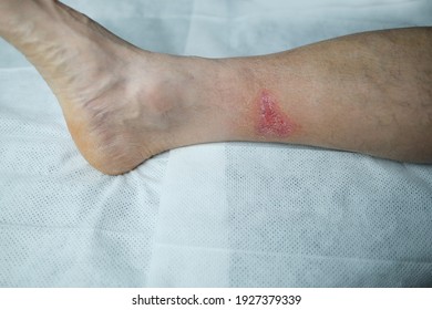 Early Stage Filariasis Stock Photo (Edit Now) 1113683006