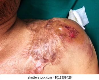 Large Keloid Scar From Burn