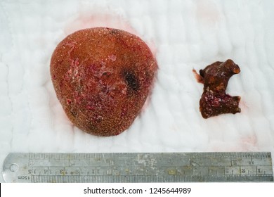 Large  Kidney Stone Or Renal Calculus After Surgery In Hospital.