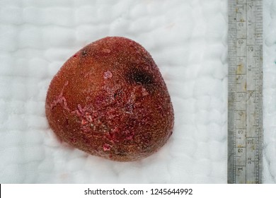 Large  Kidney Stone Or Renal Calculus After Surgery In Hospital.