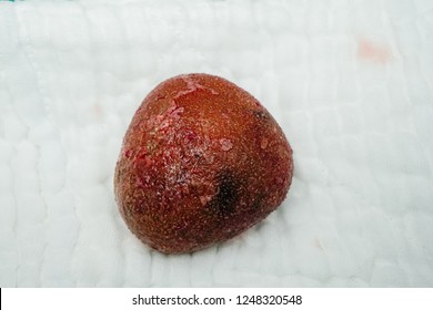 Large  Kidney Stone Or Renal Calculus After Surgery In Hospital.