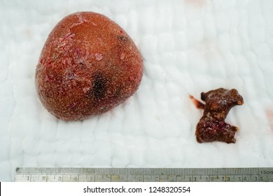 Large  Kidney Stone Or Renal Calculus After Surgery In Hospital.