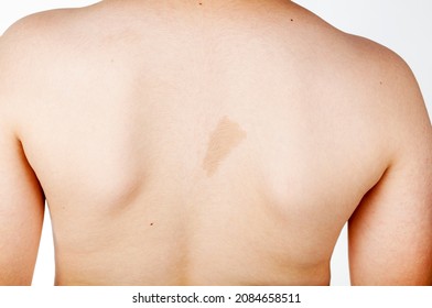 Photo of A large light brown cafe au lait spot known as birth mark on the inter scapular region of a caucasian male. This benign skin discoloration may be related to a genetical disorder neurofibromatosis.