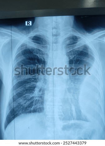 Large mass at left side of chest compresing lung parenchyma resulting cimpression collapse and mediastinal shifting suggesting pleural mesothelioma