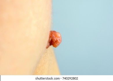 large mole on the neck, removal of moles nevus or warts concept
