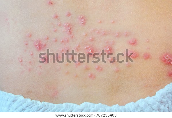 赤ちゃんの背中に赤い発疹が多い 赤ん坊の背中には発疹と膿が出ている の写真素材 今すぐ編集