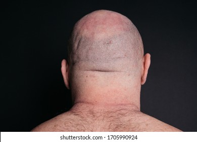 Large, Overweight Man Stands With His Back To Me.
Bald Head On A Black Background. Concept: Body Parts And Anatomy