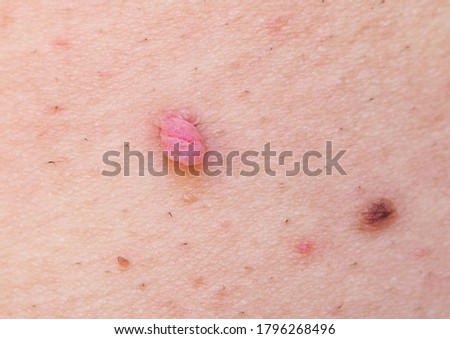 Large papilloma and a mole on the skin of the armpit. Human Papilloma Virus.