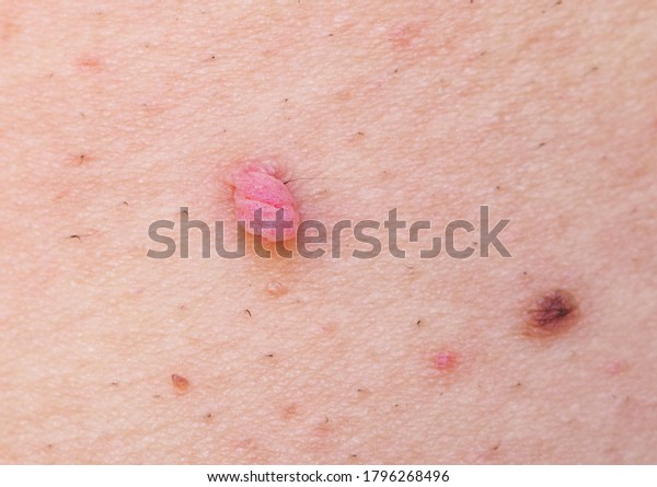 Large papilloma and a mole on the skin of the\
armpit. Human Papilloma\
Virus.