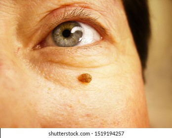 papilloma on your face