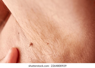 Large papilloma under the armpit of a man. Skin disease. Skin care. - Shutterstock ID 2264800929