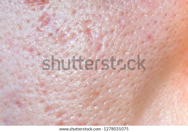 Large Pores Close Has Skin Problem Stock Photo 1278031075 | Shutterstock