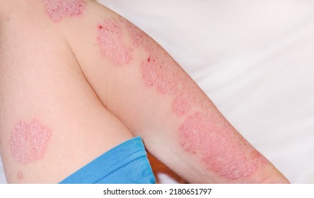 Large red inflamed scaly rash on the hands. Acute psoriasis on the arm of a man, severe redness on the skin, an autoimmune incurable dermatological skin disease. Red redness, spots on the skin.