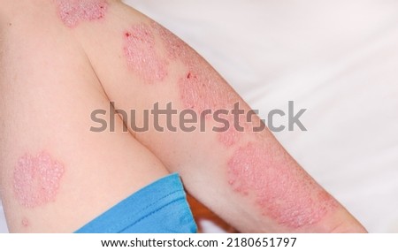 Large red inflamed scaly rash on the hands. Acute psoriasis on the arm of a man, severe redness on the skin, an autoimmune incurable dermatological skin disease. Red redness, spots on the skin.