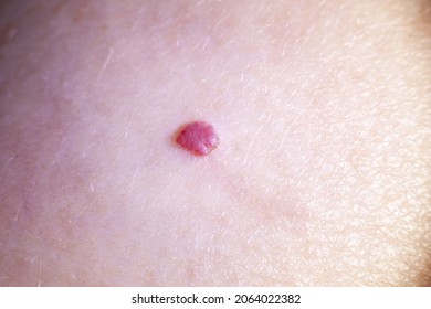 801 Red Moles On Body Images, Stock Photos & Vectors | Shutterstock