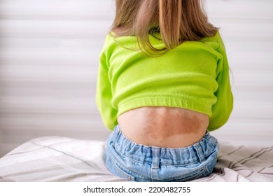 Large Red-brown Spot On Lower Back Of Child From Birth. Removal Of Skin Pigmentation And Vascular Malformation. Congenital Abnormality Of Structure Of Blood Vessels. Methods Of Treatment Of Laser 