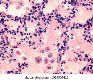 Large Rounded Macrophages Liquid Pulmonary Edema Stock Photo Edit Now 1054509413