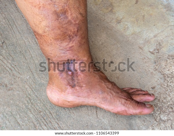 A large scar on the leg and\
foot of Asian man, from car or motorbike accident, deep tissue\
scar.