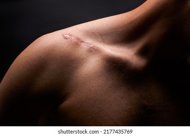 Large Scar On  Male Shoulder After Surgery Operation Isolated On Black Background.