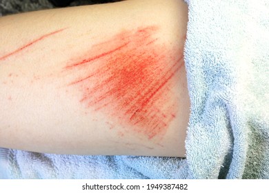 A Large Skin Abrasion On A Leg