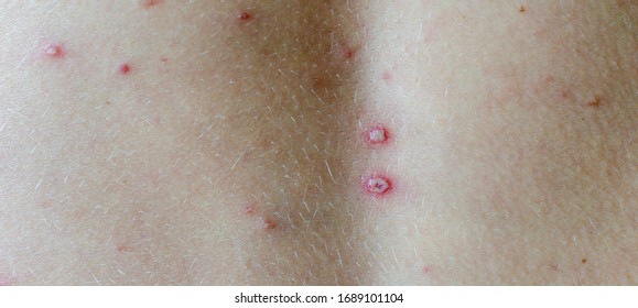 Adult With Chicken Pox Stock Photos Images Photography Shutterstock