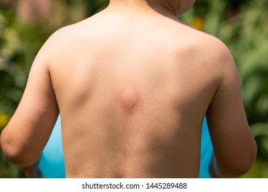 Large Swollen Insect Bite Mark On Baby's Back