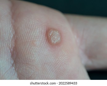 Large Wart On Hand Isolated On Stock Photo 2022589433 | Shutterstock