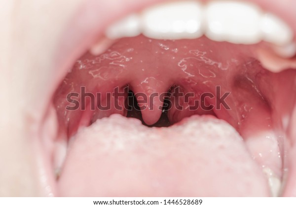 Larynx throat glands tongue viral lingitis\
inflammation of tonsils mouth for\
medicine\
