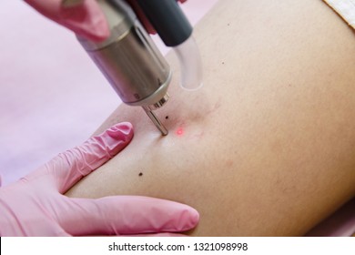 Laser Capillary Removal