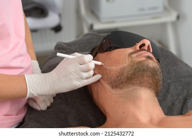 Laser Hair Removal On Mans Face. Man In A Goggles.