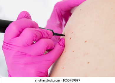 Laser Skin Mole Removal