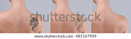 Laser tattoo removal before and after. Beautiful young woman with tattoo on her back. 