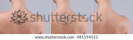 Laser tattoo removal before and after. Beautiful young woman with tattoo on her back.