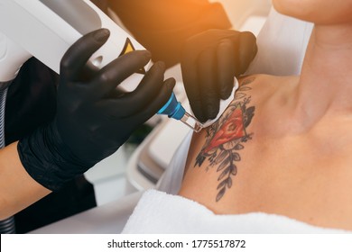 Laser Tattoo Removal From Shoulder